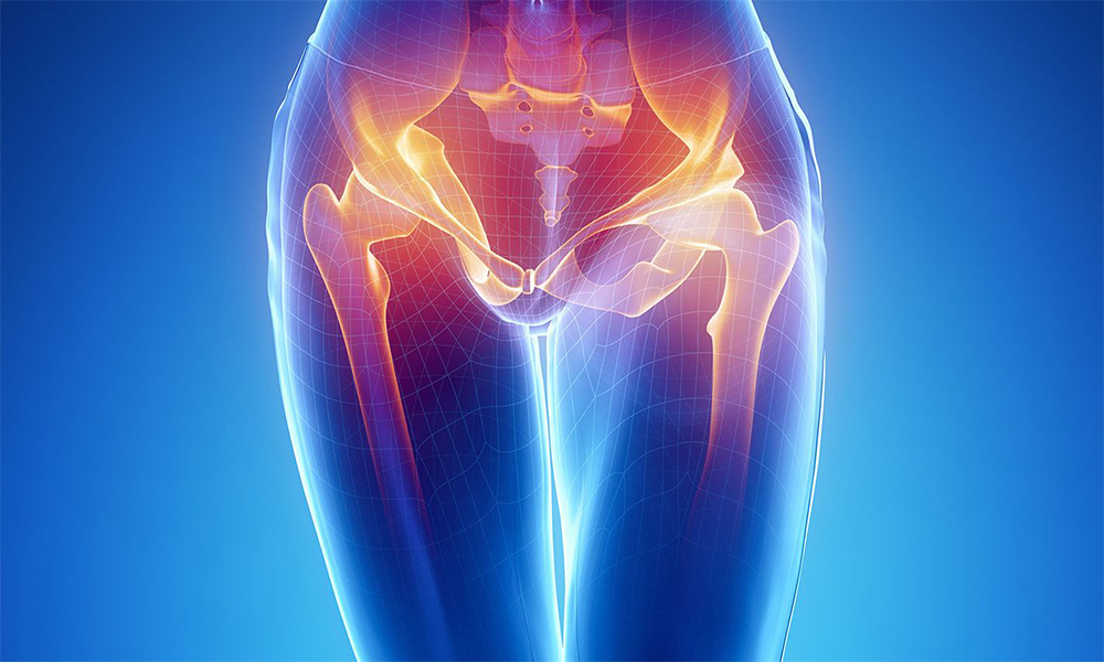 Kalçada Kireçlenme Tedavisi Kalçada Kireçlenme Tedavisi