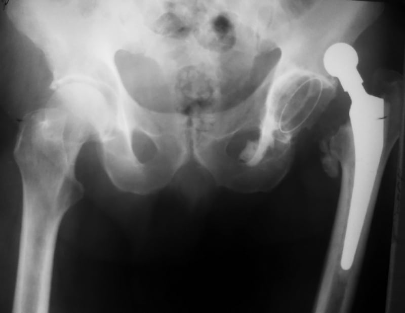 Kalça Çıkığı Kalça Çıkığı