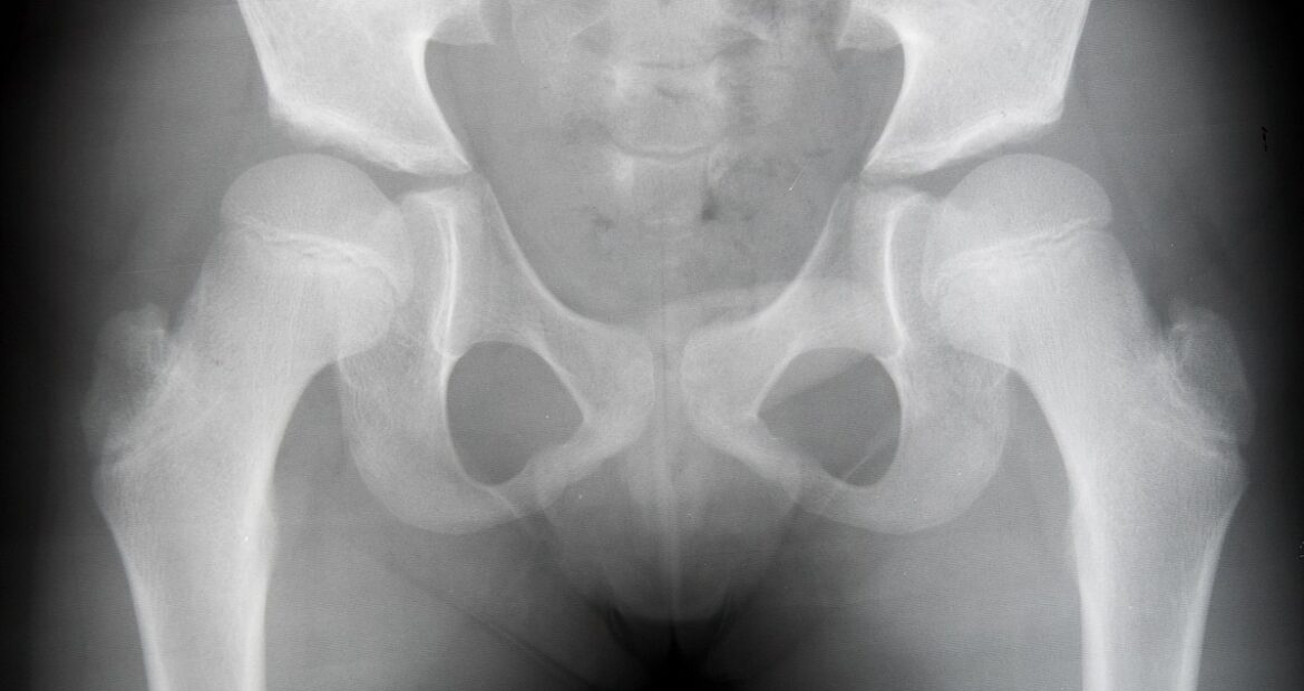 Kalça Çıkığı Kalça Çıkığı