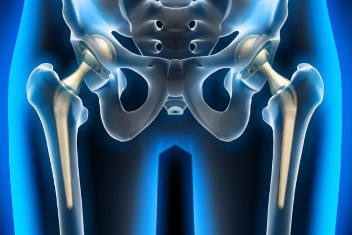 Kalça Çıkığı Kalça Çıkığı