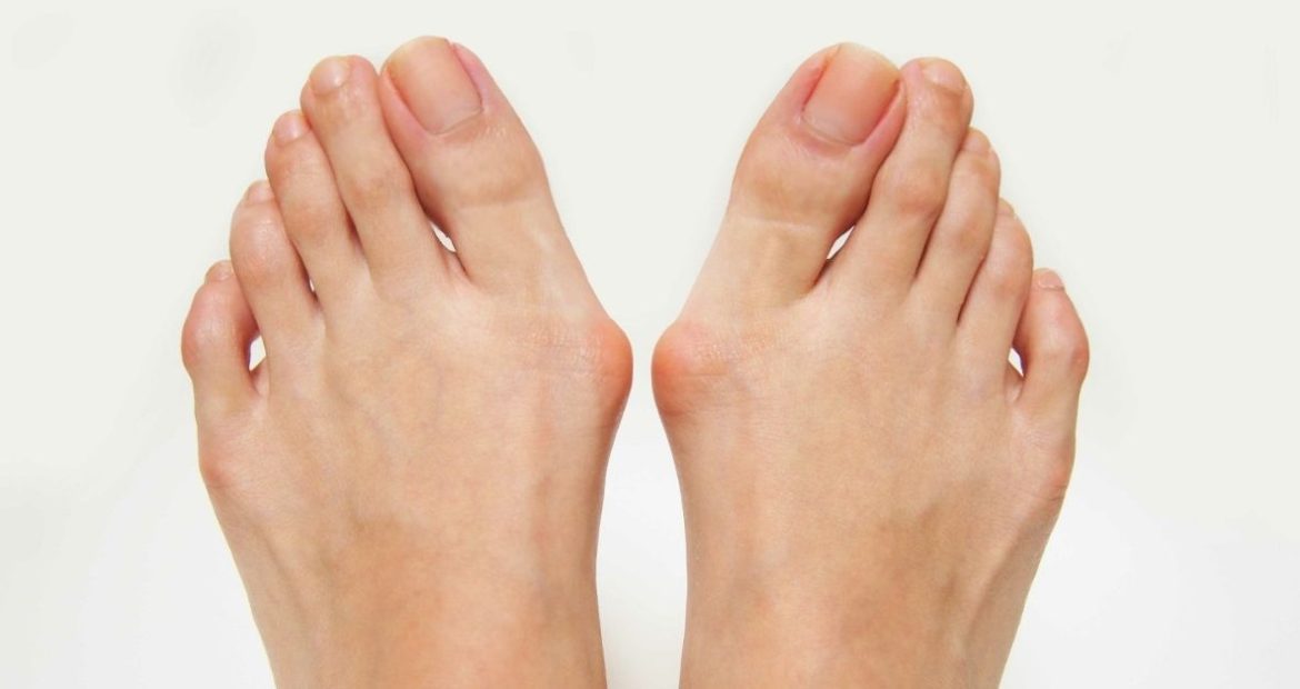 Halluks Valgus Ameliyatı Halluks Valgus Ameliyatı