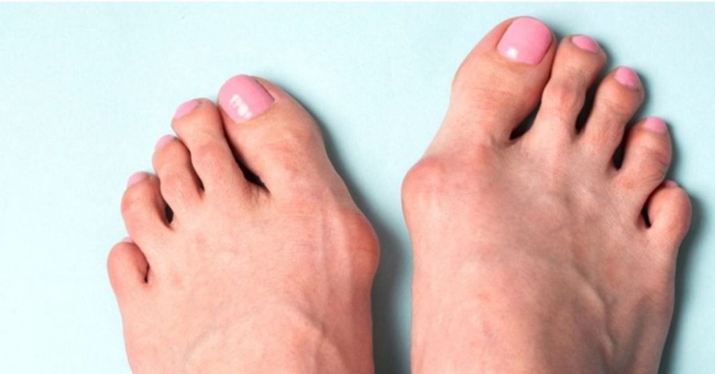 Halluks Valgus Ameliyatı Halluks Valgus Ameliyatı