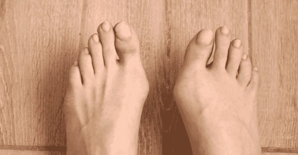 Halluks Valgus Ameliyatı Halluks Valgus Ameliyatı